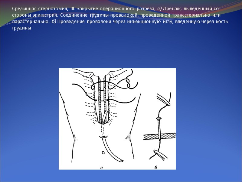 Срединная стернотомия, III. Закрытие операционного разреза, а) Дренаж, выведенный со стороны эпигастрия. Соединение грудины